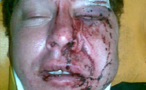 Former NRL star Jason Ferris is undergoing corrective facial surgery this week. Former NRL star Jason Ferris is undergoing corrective facial surgery this week.