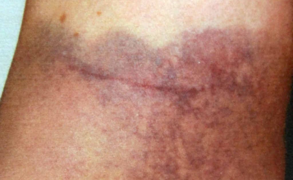 Bruising on a Goonellabah woman, suffered as a result of an assault by a police officer. Bruising on a Goonellabah woman, suffered as a result of an assault by a police officer.
