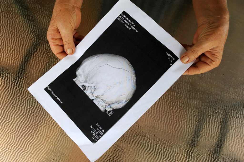 ONE PUNCH: Tyla Rackemann's fractured skull. Photo: Mike Knott / NewsMail ONE PUNCH: Tyla Rackemann's fractured skull. Photo: Mike Knott / NewsMail