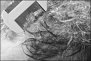 A fine-tooth comb and head lice treatment shampoo are effective ways to remove head lice and nits. A fine-tooth comb and head lice treatment shampoo are effective ways to remove head lice and nits.