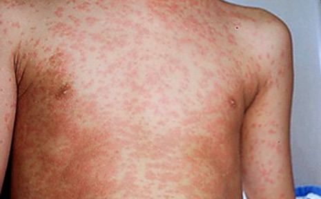 An image of an adult suffering a measles infection An image of an adult suffering a measles infection
