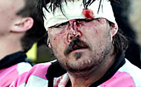 Wollongbar-Alstonville captain Matt Scott nurses battle wounds from Saturday's clash with Coolangatta-Tweed. Wollongbar-Alstonville captain Matt Scott nurses battle wounds from Saturday's clash with Coolangatta-Tweed.