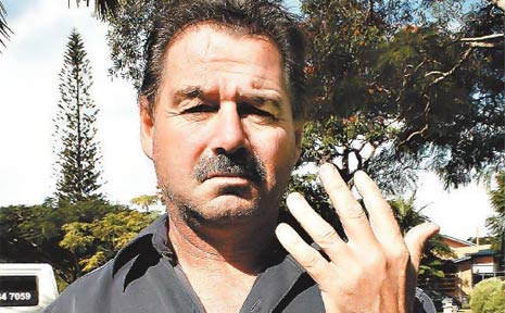 Car crash victim Micahel Porter shows where his wedding ring has been for 15 years. Car crash victim Micahel Porter shows where his wedding ring has been for 15 years.