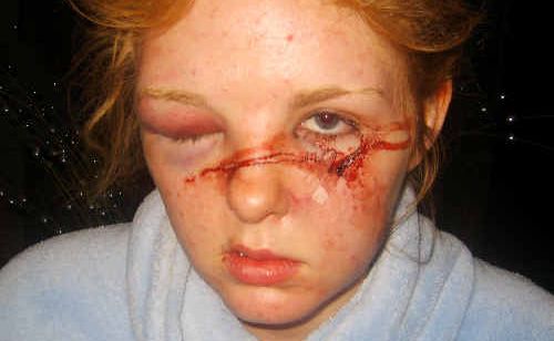 Emma Guy, 17, suffered shocking facial injuries when she was attacked at a party. Emma Guy, 17, suffered shocking facial injuries when she was attacked at a party.