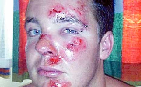 A battered and bruised Dayne Burns after allegedly being set upon by a group of attackers on Yamba hill. A battered and bruised Dayne Burns after allegedly being set upon by a group of attackers on Yamba hill.