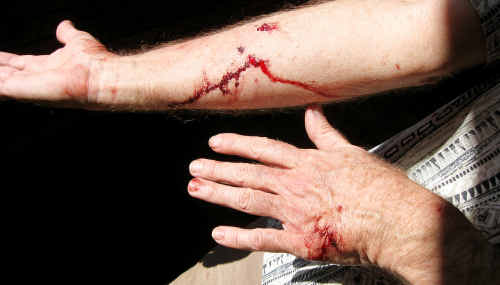 The bite wounds inflicted on Fr McDonald in the dog attack. The bite wounds inflicted on Fr McDonald in the dog attack.