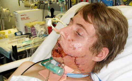 Tori Field suffered serious facial injuries in an explosion at his home in Fernvale. Tori Field suffered serious facial injuries in an explosion at his home in Fernvale.
