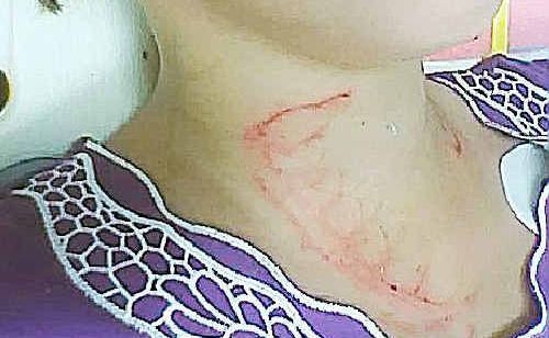 HORSE BITE: Brianne in hospital after the vicious horse attack on Saturday. HORSE BITE: Brianne in hospital after the vicious horse attack on Saturday.