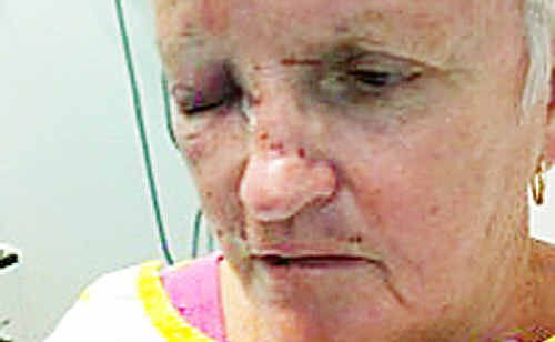 Casino woman Diane Davis, 63, may require surgery for injuries she received when viciously assaulted outside her home on Tuesday night. Casino woman Diane Davis, 63, may require surgery for injuries she received when viciously assaulted outside her home on Tuesday night.