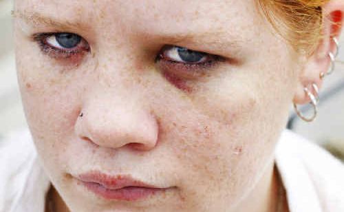 Holly Scales shows her bruised eye after she was assaulted and robbed at the University of Queensland Gatton campus. Holly Scales shows her bruised eye after she was assaulted and robbed at the University of Queensland Gatton campus.
