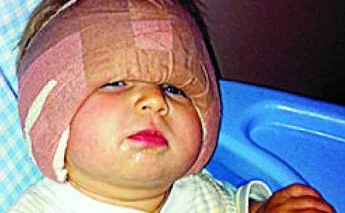 The bandages after surgery were so heavy Amy could barely lift her head. The bandages after surgery were so heavy Amy could barely lift her head.