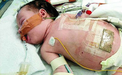 Ten-week-old Mia in the pediatric intensive care unit of the Royal Brisbane Children’s Hospital after undergoing her third major operation after being born with the birth defect gastroschisis. Ten-week-old Mia in the pediatric intensive care unit of the Royal Brisbane Children’s Hospital after undergoing her third major operation after being born with the birth defect gastroschisis.