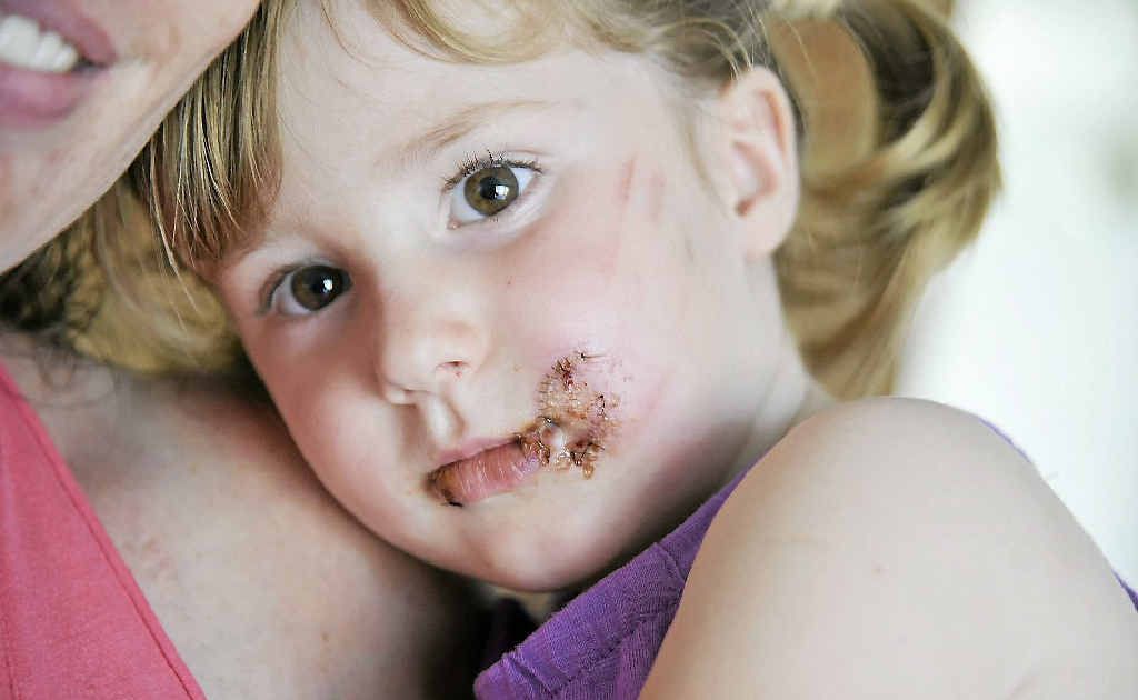 Aleeah Boase, 3, who was attacked by a dog in Tannum Sands. Aleeah Boase, 3, who was attacked by a dog in Tannum Sands.