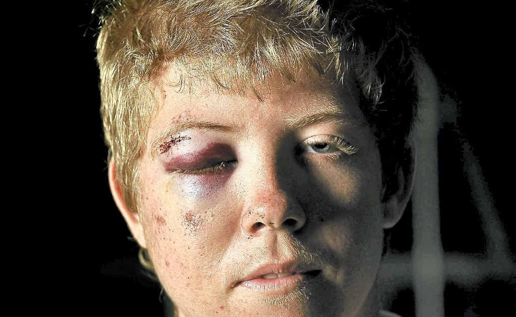 Lachlan Limdach after being attacked in Noosa on Saturday night. Lachlan Limdach after being attacked in Noosa on Saturday night.