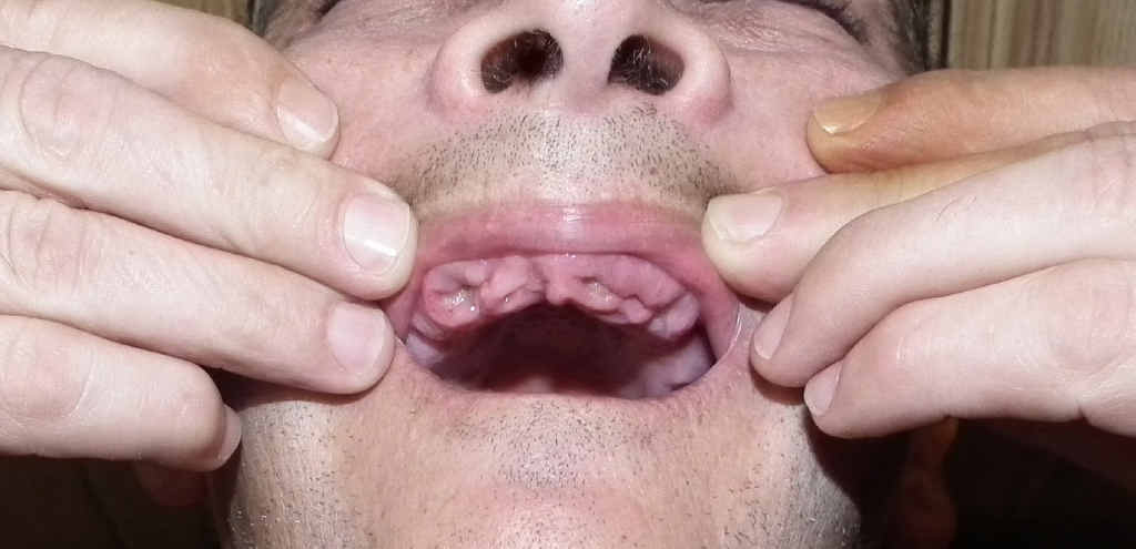 A Maryborough man is devastated after a dentist mistakenly removed his upper teeth instead of repairing them. A Maryborough man is devastated after a dentist mistakenly removed his upper teeth instead of repairing them.