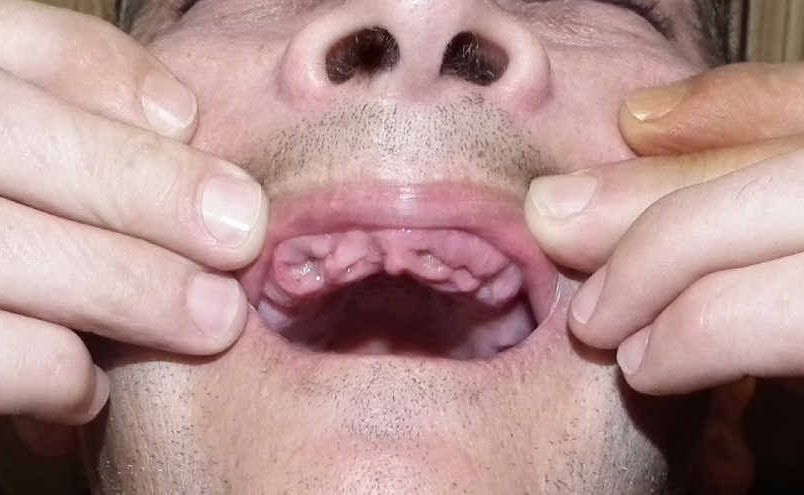 A Maryborough man is devastated after a dentist mistakenly removed his upper teeth instead of repairing them. A Maryborough man is devastated after a dentist mistakenly removed his upper teeth instead of repairing them.
