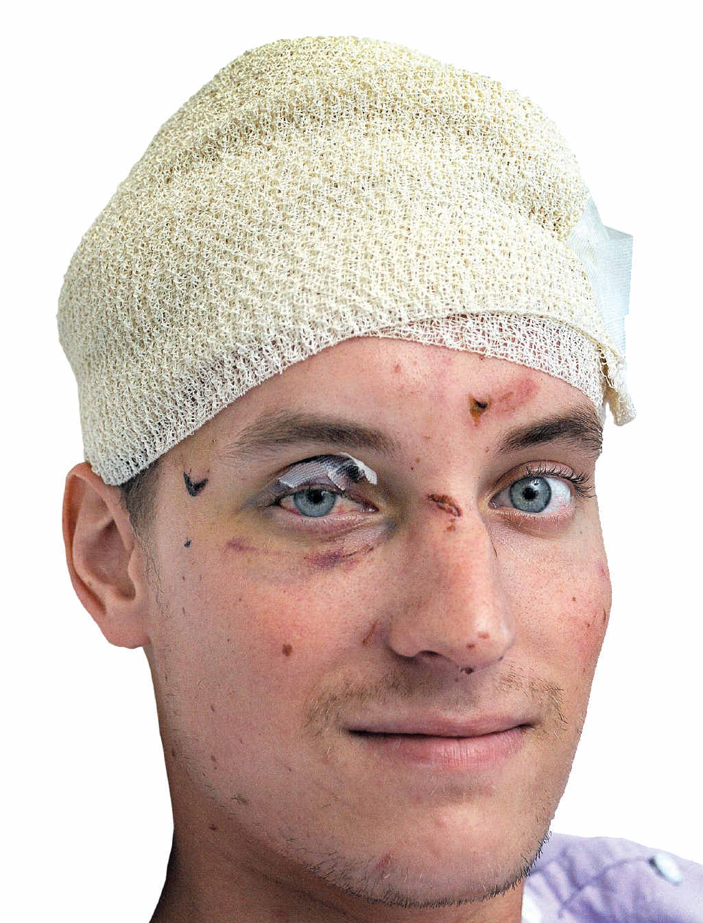 German tourist Justin recovering in Hervey Bay Hospital after being mauled by dingoes on Fraser Island. German tourist Justin recovering in Hervey Bay Hospital after being mauled by dingoes on Fraser Island.