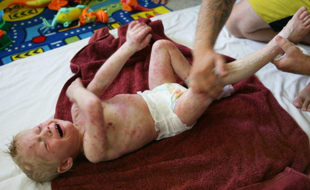 Troy Kunst covers his son Lincoln (4), who suffers from an extreme case of eczema, with a soothing cream in an effort to stop the irritation Photo: Chris Ison / The Morning Bulletin Troy Kunst covers his son Lincoln (4), who suffers from an extreme case of eczema, with a soothing cream in an effort to stop the irritation Photo: Chris Ison / The Morning Bulletin
