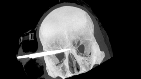 The blade penetrated nearly halfway through the 20-year-old Christchurch man's head. The blade penetrated nearly halfway through the 20-year-old Christchurch man's head.