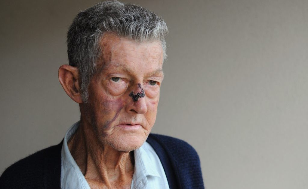 Robert Turvey suffered a broken nose after being attacked near his Anzac Avenue home. Robert Turvey suffered a broken nose after being attacked near his Anzac Avenue home.