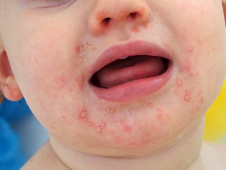 After attending a local child care for three days, a local child has received a major case of hand, foot and mouth disease. After attending a local child care for three days, a local child has received a major case of hand, foot and mouth disease.