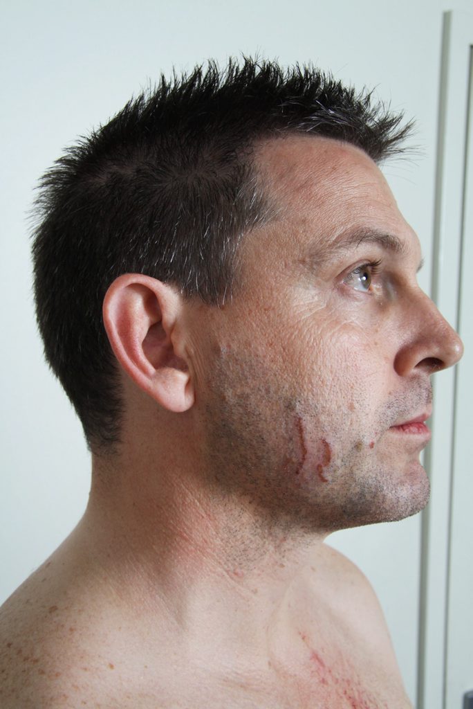 Police photographs of marks on Gerard Baden-Clay's skin used as evidence in court. Police photographs of marks on Gerard Baden-Clay's skin used as evidence in court.