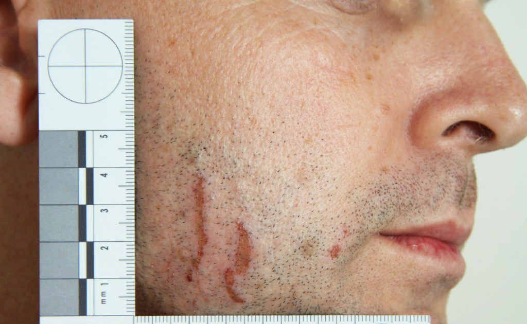 IN EVIDENCE: Police photographs of marks on Gerard Baden-Clay’s skin used as evidence in court. IN EVIDENCE: Police photographs of marks on Gerard Baden-Clay’s skin used as evidence in court.