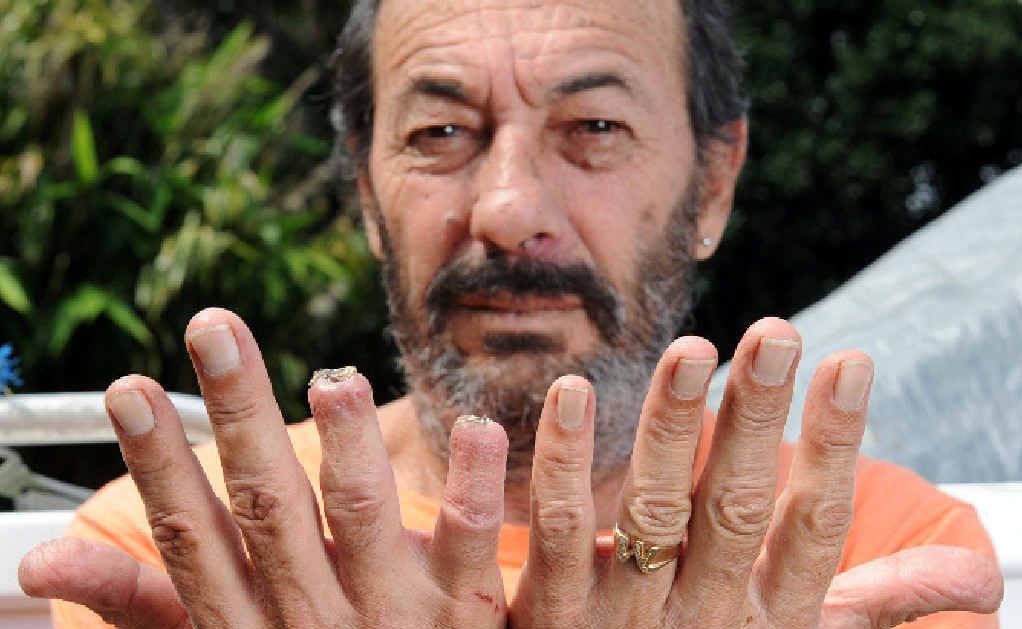Peter Mitchell of Lennox Head lost the end of two fingers in a boating accident when his hand became entangled in a crap pot rope that was suspended from a Ballina bridge. Peter Mitchell of Lennox Head lost the end of two fingers in a boating accident when his hand became entangled in a crap pot rope that was suspended from a Ballina bridge.