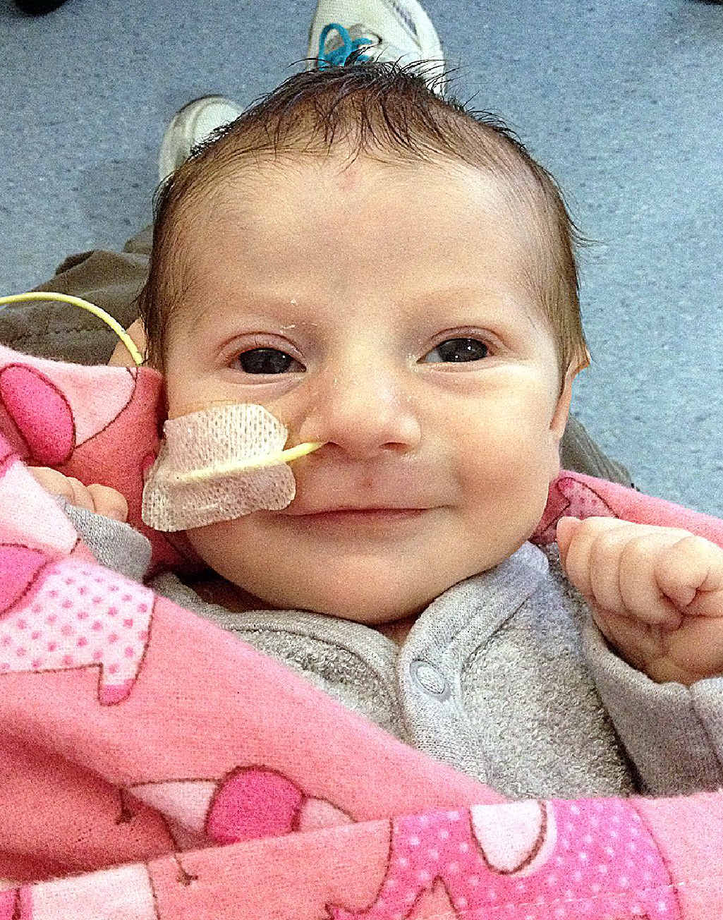 Emily Grace Wilson has hypoplastic left heart syndrome. Emily Grace Wilson has hypoplastic left heart syndrome.