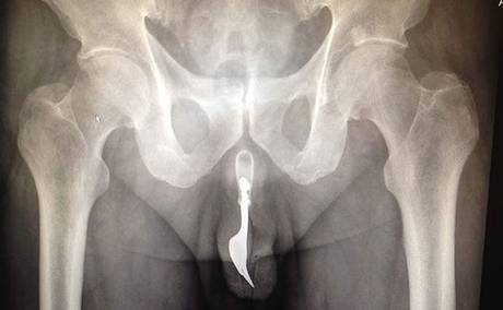 Xray großen Penis