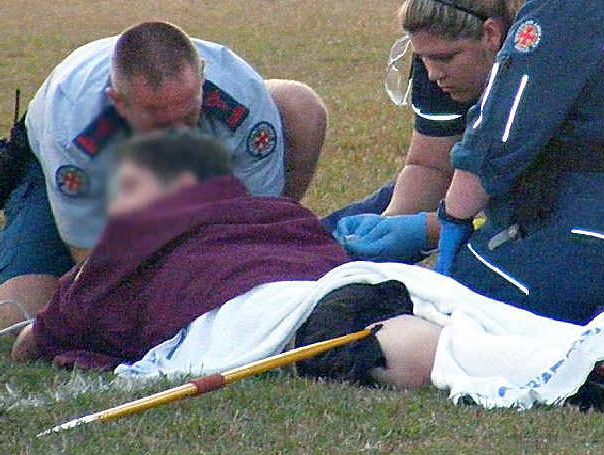 A Sunshine Coast teenager had his leg pierced by a javelin. A Sunshine Coast teenager had his leg pierced by a javelin.