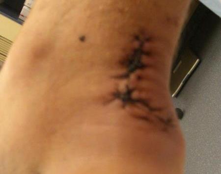 Brendan Clarke had to have his achilles tendon put back together after it was severed by a glassing incident at a private party. Brendan Clarke had to have his achilles tendon put back together after it was severed by a glassing incident at a private party.