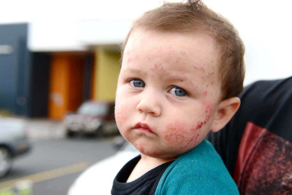 Vann Breingan, age 13m, battles with eczema. Photo Sharyn O'Neill / The Morning Bulletin Vann Breingan, age 13m, battles with eczema. Photo Sharyn O'Neill / The Morning Bulletin