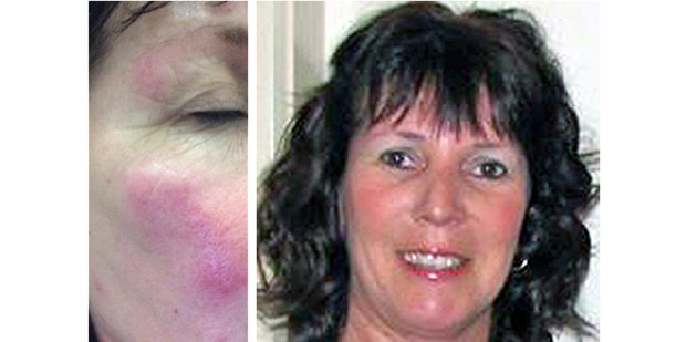 Debbie Roome had an allergic reaction after being bitten by bed bugs at an airport motel. Debbie Roome had an allergic reaction after being bitten by bed bugs at an airport motel.