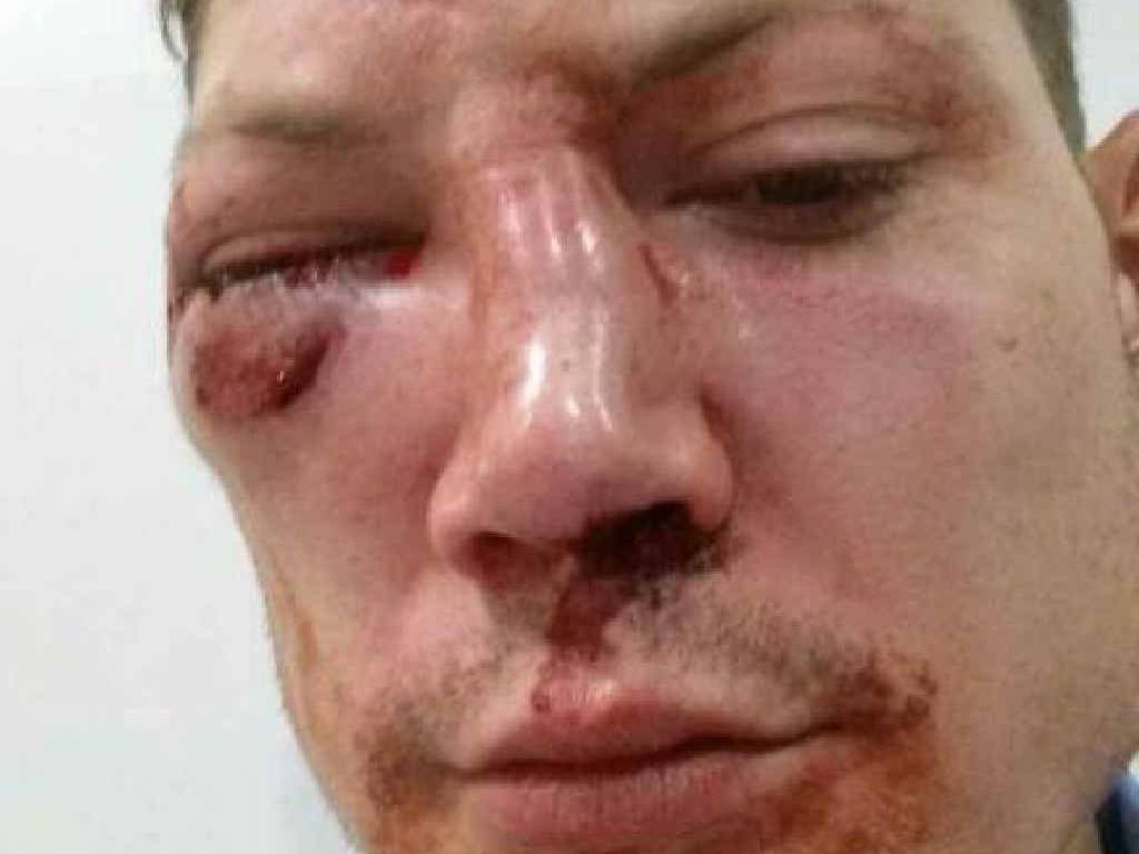 ASSAULTED: Pieter Tjerkstra was beaten at a nightclub Sunday morning. ASSAULTED: Pieter Tjerkstra was beaten at a nightclub Sunday morning.