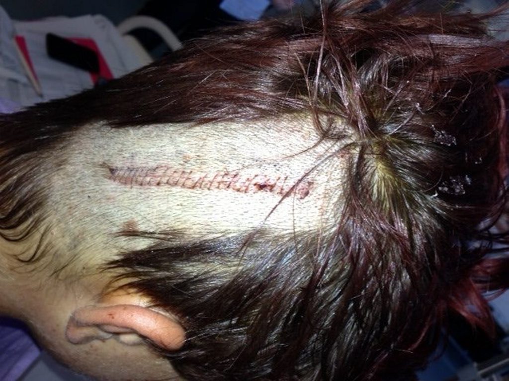 The 24 stitches Matt Bonney received after a nasty fall from his skateboard in May. The 24 stitches Matt Bonney received after a nasty fall from his skateboard in May.