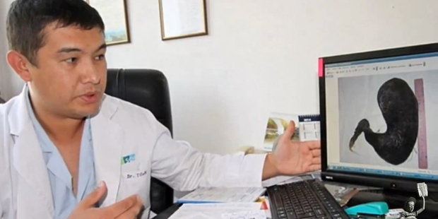 Bishkek Hospital's senior professor of surgery, Bahadir Bebezov examines the hair ball. Photo / YouTube Bishkek Hospital's senior professor of surgery, Bahadir Bebezov examines the hair ball. Photo / YouTube
