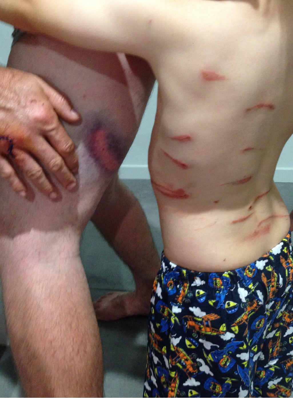 AFTERMATH: The injuries caused to Vinnie Hall and his father Michael. AFTERMATH: The injuries caused to Vinnie Hall and his father Michael.