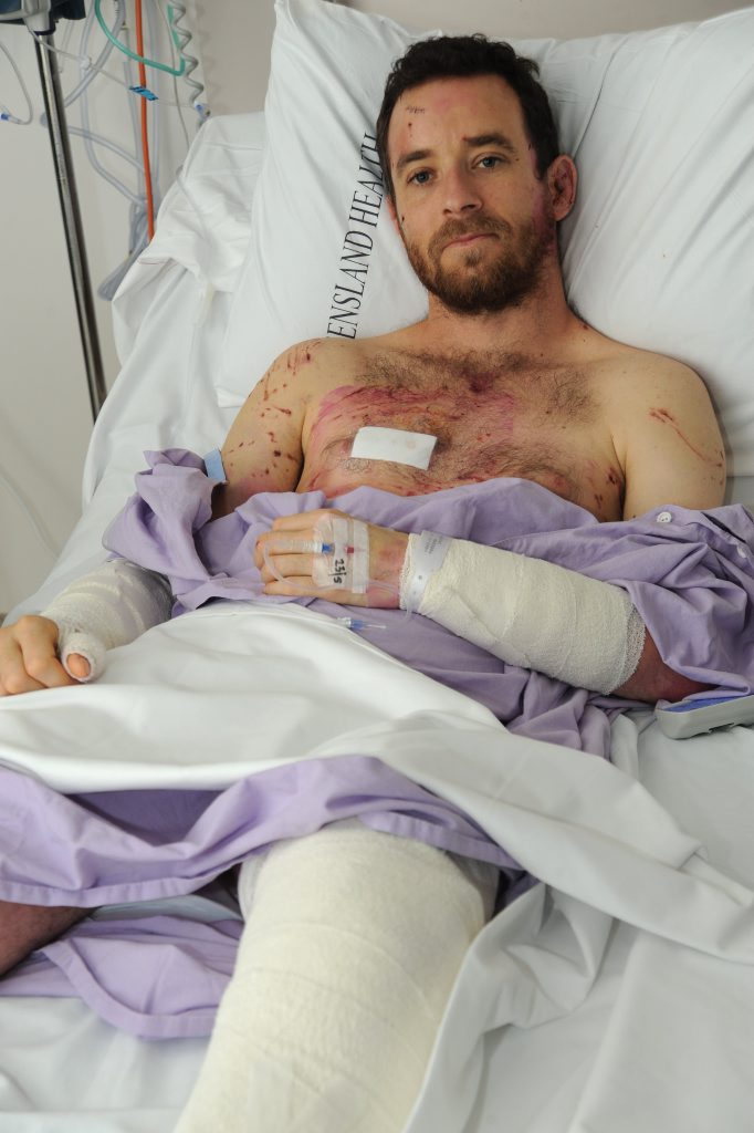 Timo Fuchs in Nambour General Hospital after suffering an horrific dog attack leaving him with a broken leg and multiple cuts and bruises. Photo: Iain Curry / Sunshine Coast Daily Timo Fuchs in Nambour General Hospital after suffering an horrific dog attack leaving him with a broken leg and multiple cuts and bruises. Photo: Iain Curry / Sunshine Coast Daily