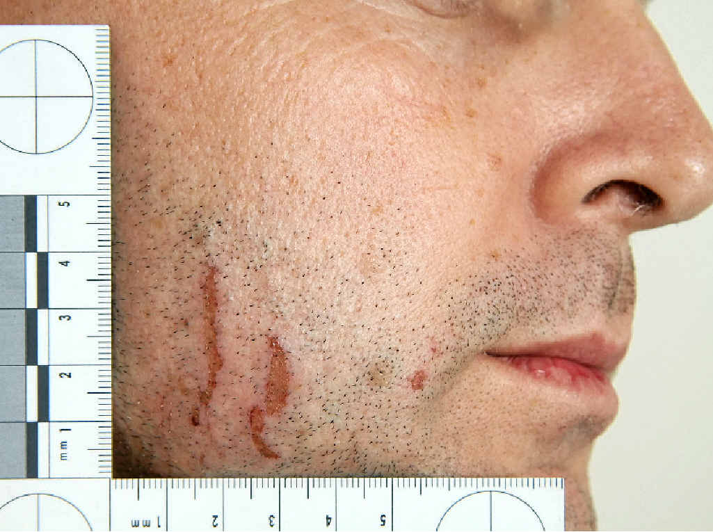 Police photographs of marks on Gerard Baden-Clay’s skin were used in evidence in his murder trial. Police photographs of marks on Gerard Baden-Clay’s skin were used in evidence in his murder trial.