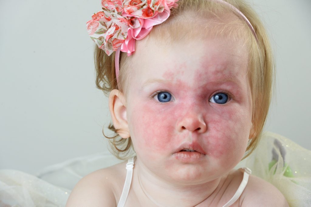 LITTLE CUTIE: Sophia Lonergan was born with Sturge-Weber Syndrome, a condition her parents are trying to raise awareness about. LITTLE CUTIE: Sophia Lonergan was born with Sturge-Weber Syndrome, a condition her parents are trying to raise awareness about.