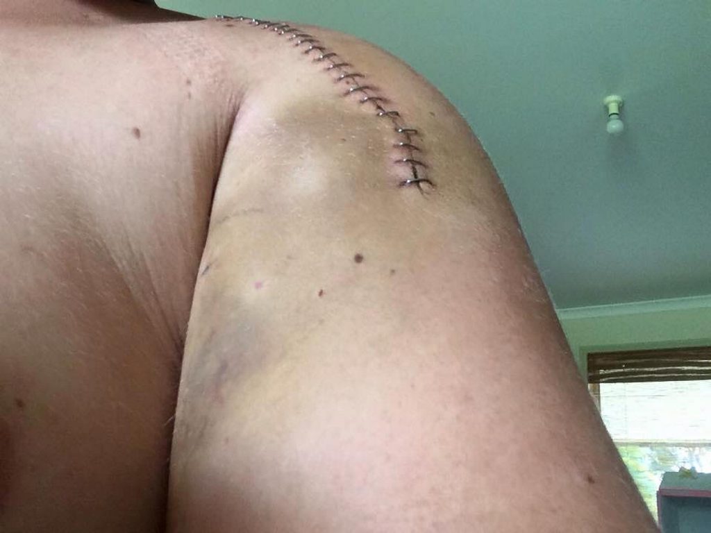 Dalton's shoulder staples. Dalton's shoulder staples.