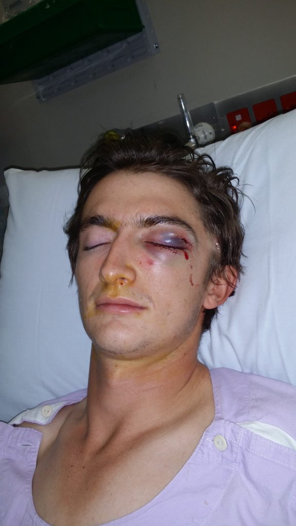 Cameron Kanofski in hospital last year after an assault outside the Portadown Hotel in Toowoomba left him with three cheekbone fractures and a fractured eye socket. Cameron Kanofski in hospital last year after an assault outside the Portadown Hotel in Toowoomba left him with three cheekbone fractures and a fractured eye socket.