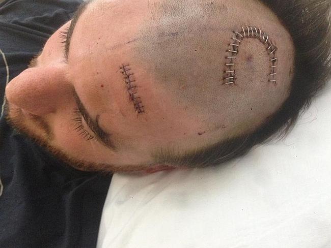 The lump found on Darren Jolly's brain was a benign cyst. The lump found on Darren Jolly's brain was a benign cyst.