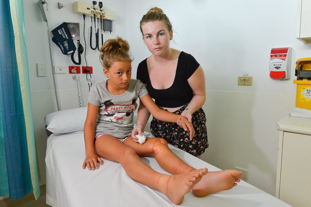 STUNG: Ebony Persad is lucky to be alive after being stung by a box jellyfish. STUNG: Ebony Persad is lucky to be alive after being stung by a box jellyfish.