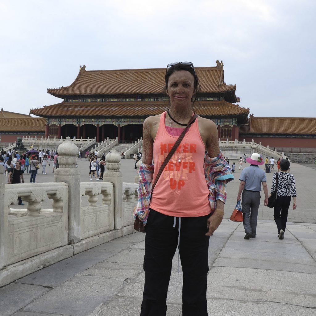 In this June 2, 2014 photo released by Interplast Australia & New Zealand, Turia Pitt stands in front of Forbidden Temple during a walk of almost 95 kilometers (59 miles) in eight days across the Great Wall of China. In this June 2, 2014 photo released by Interplast Australia & New Zealand, Turia Pitt stands in front of Forbidden Temple during a walk of almost 95 kilometers (59 miles) in eight days across the Great Wall of China.