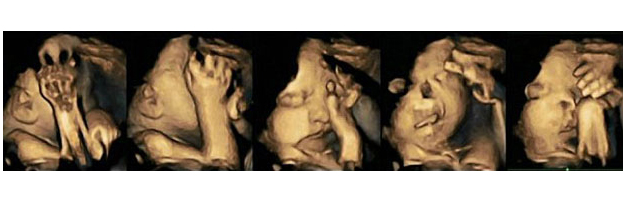 An unborn baby in the womb of a woman who smokes, notice how it is touching its face compared to the bub pictured above An unborn baby in the womb of a woman who smokes, notice how it is touching its face compared to the bub pictured above