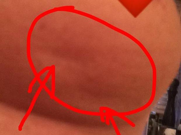 Breast cancer patient Lisa Royle posted a photo of 'subtle dimples' that alerted her to illness. Breast cancer patient Lisa Royle posted a photo of 'subtle dimples' that alerted her to illness.