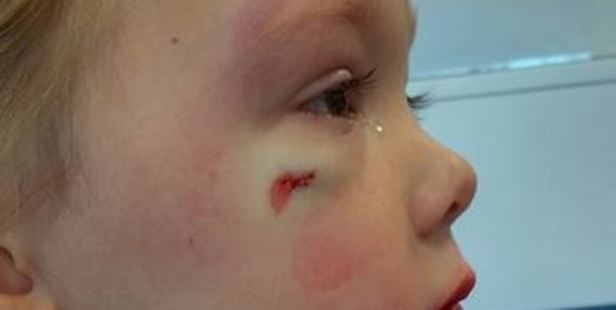 A 4-year-old requires stitches after being hit by a boy in her class. A 4-year-old requires stitches after being hit by a boy in her class.