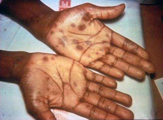 Secondary stage syphilis sores (lesions) on the palms of the hands. Source: CDC Secondary stage syphilis sores (lesions) on the palms of the hands. Source: CDC
